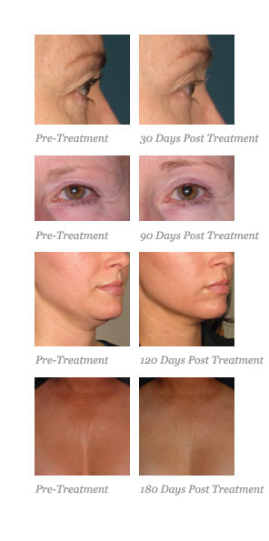 Before and After Ultherapy
